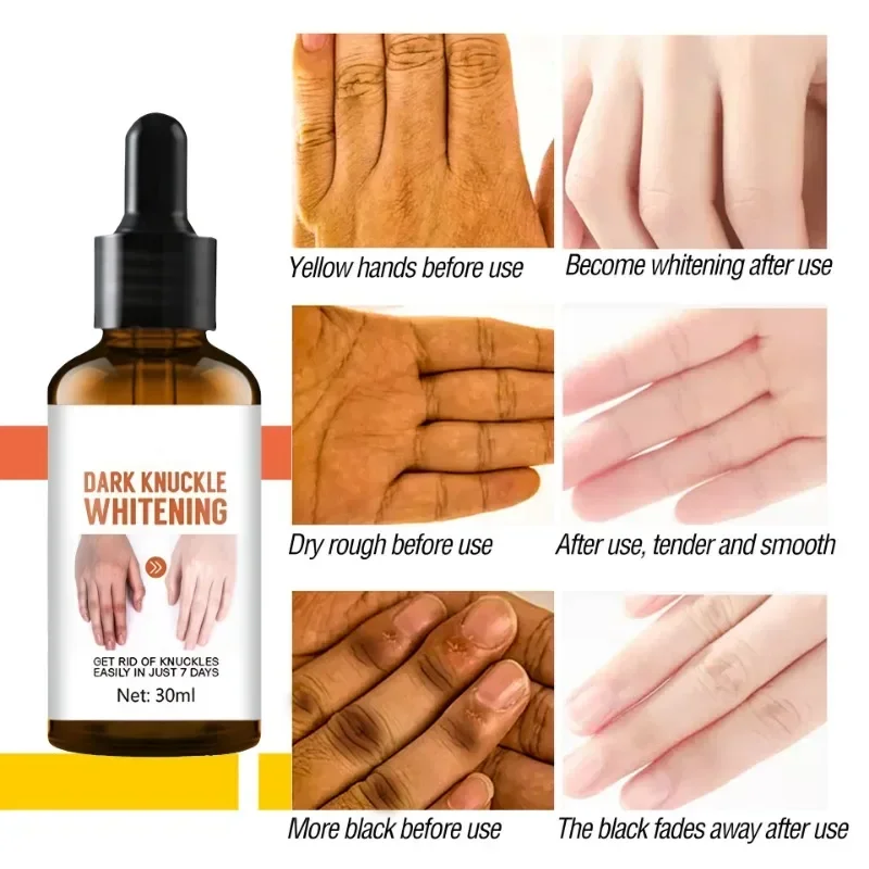 Осветляет кожу частных частей подмышек локтей осветляет меланин крем для рук