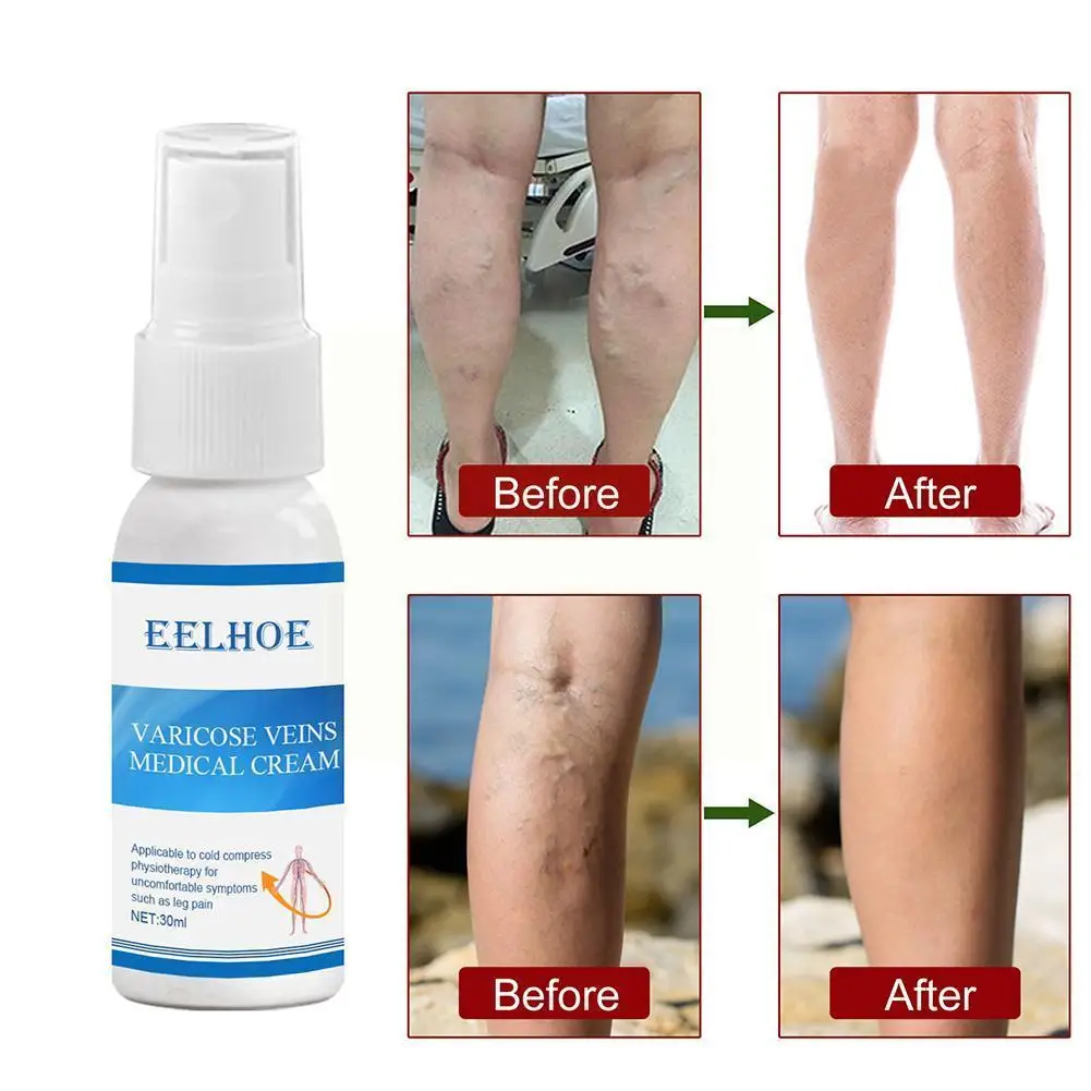 

30g Varicose Vein Soothing Spray Veins Treatment Spray Acid Lumps Solution Leg Itching On Leg Cure Earthworm Natural Bad Bi I2j3