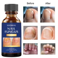 nail fungus treatment feet care essence nails foot repair toe nail fungal removal gel anti infection paronychia onychomycosis