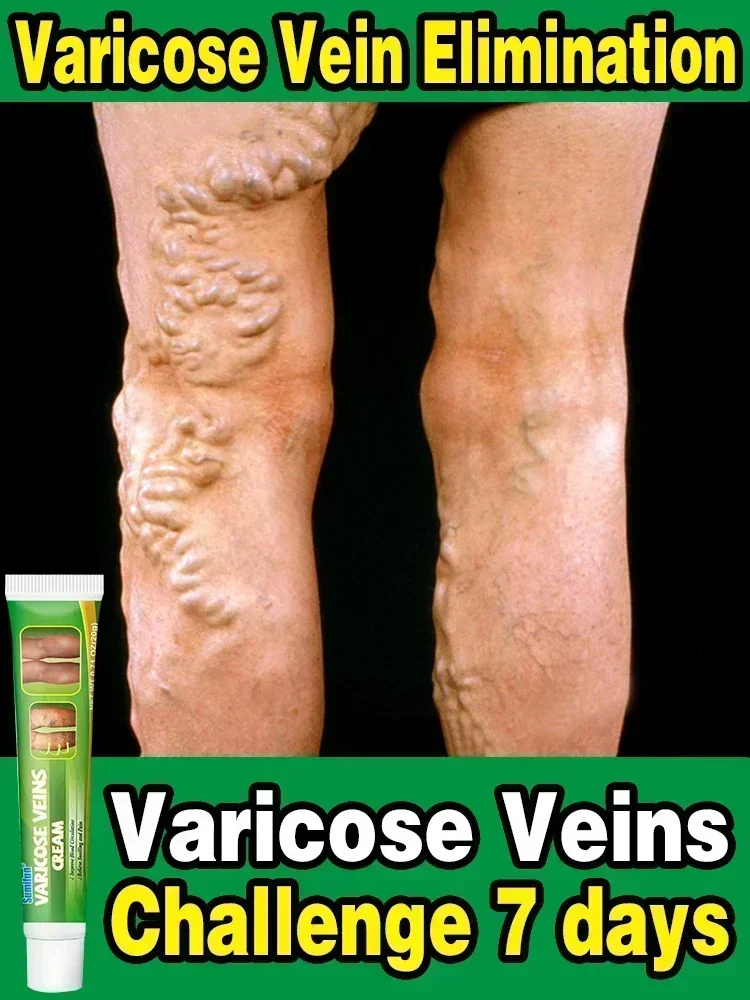 Эффективная мазь для облегчения варикозного расширения вен от - Цена: 2599