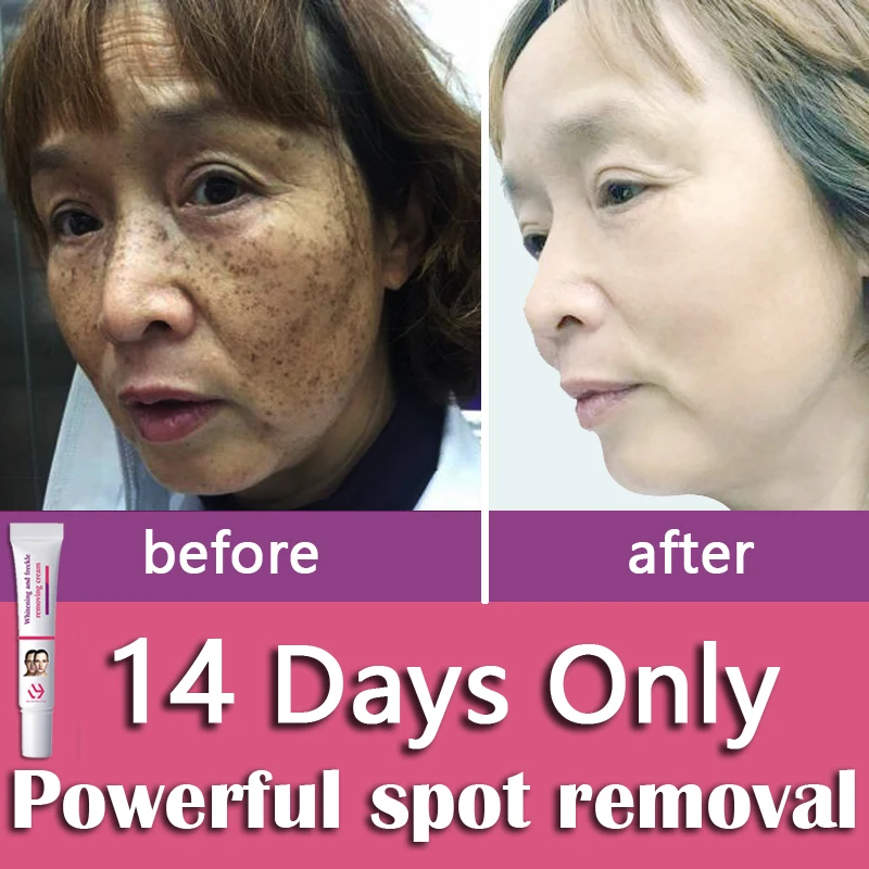 

Freckles Removal Cream Remove Facial Spots Turmeric Dark Spot Removal Melasma Age Spots Sunspots Whitening Freckle Cream Remover