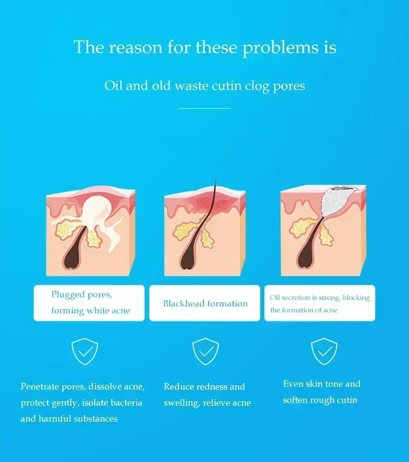 Эффективный крем для удаления акне лечение шрамов сужение пор контроль жирности