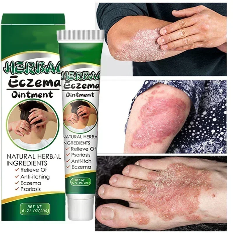 Фото Китайская Антибактериальная мазь на основе лекарственных трав при псориазе Eczma Itchy №1