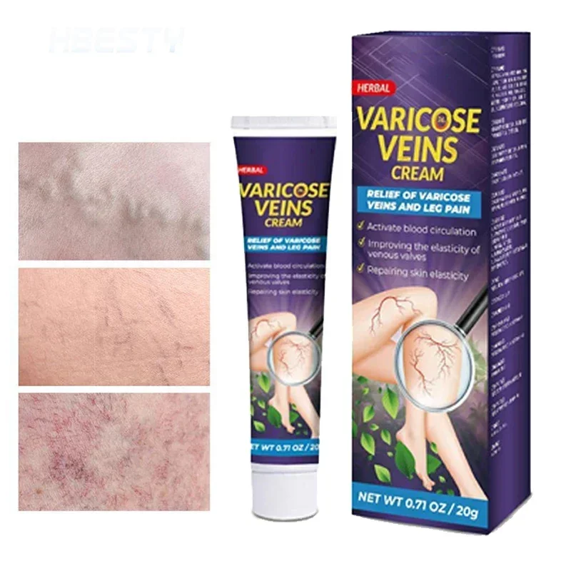 Лечение Варикозного расширения вен облегчение боли в ногах васкулит флебит паук