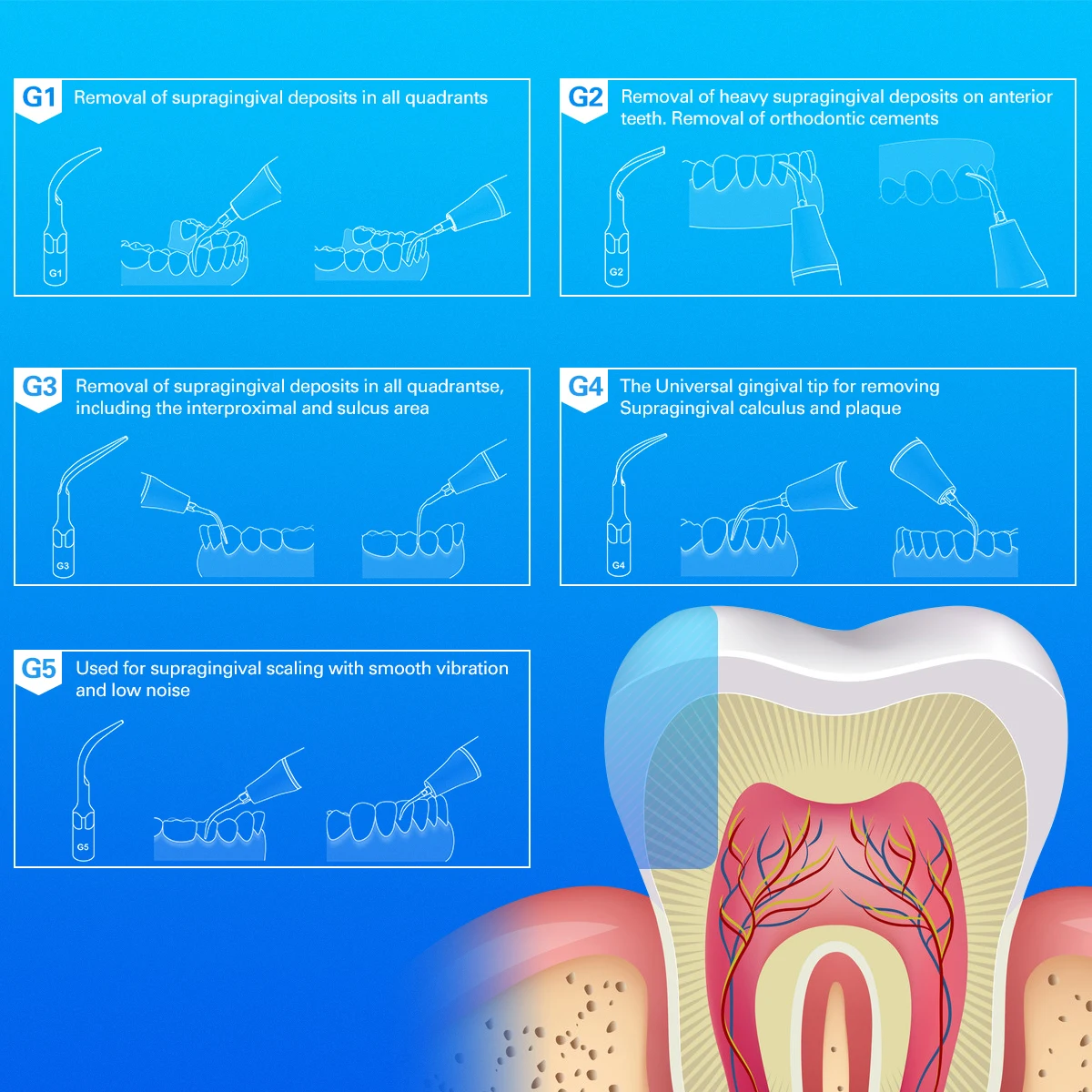 Стоматологический Ультразвуковой скалер наконечник для накидки периодонтика