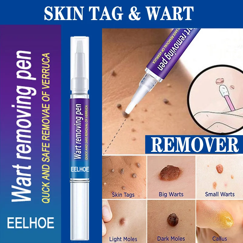 

Skin Tag Remover Pen Medical Against Moles Fast Removal Liquid Genital Wart Acne Dark Spot Treatment Anti Foot Corn Skin Care