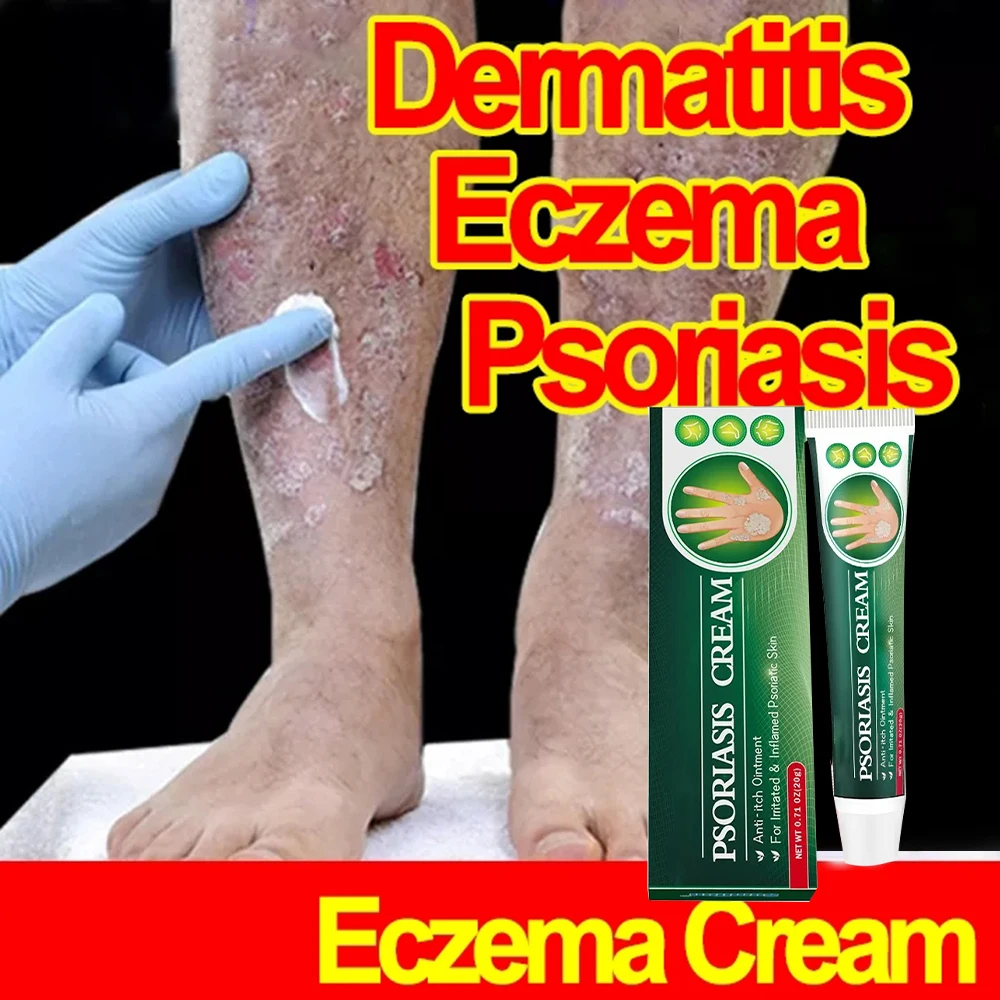 Крем от псориаза экзема кожи головы псориаз опояскивание рук запах ног щетина