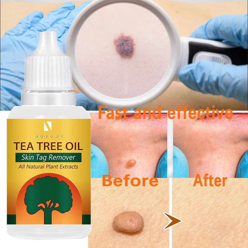 

Effectively remove wart treatment essence remove neck skin label remove nevus skin label remove skin label agent