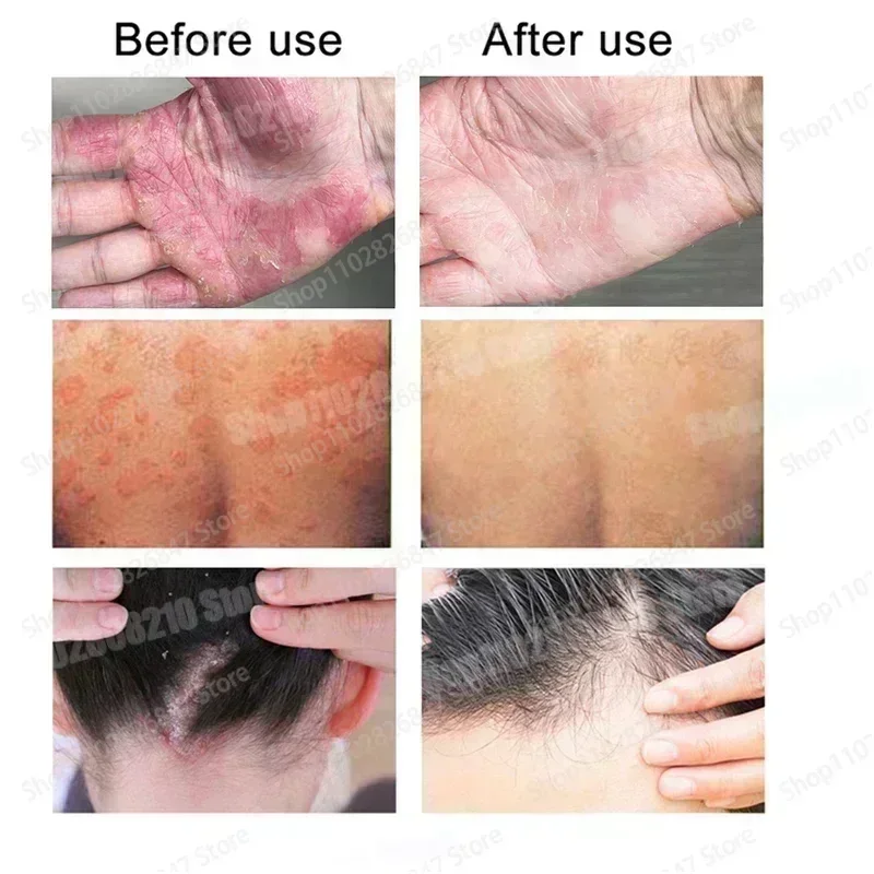 Мазь от псориаза идеально подходящая для проблем на коже крем противозудный