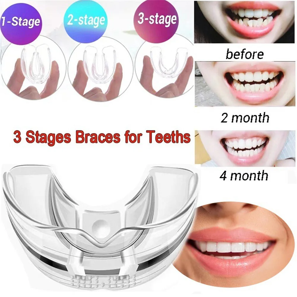 Three Stages Invisible Braces Teeth Orthodontic Aligner Straightener Transparent Braces Tooth Guard Alignment Retainer with Box
