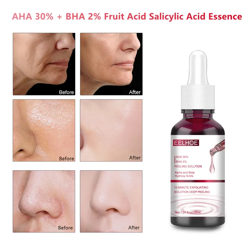 

30ml AHA 30% + BHA 2% Fruit Acid Salicylic Acid Essence Exfoliating Shrink Pores Anti Acne Serum Removal Closed Blackhead Skin