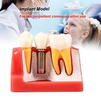 4 times dental teaching model implant analysis crown bridge demonstration denture mold set dentist removable resin false teeth