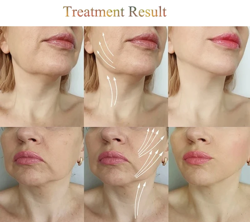 Au-8404 Auro заводская цена средство для удаления морщин шеи устройство ухода за лицом