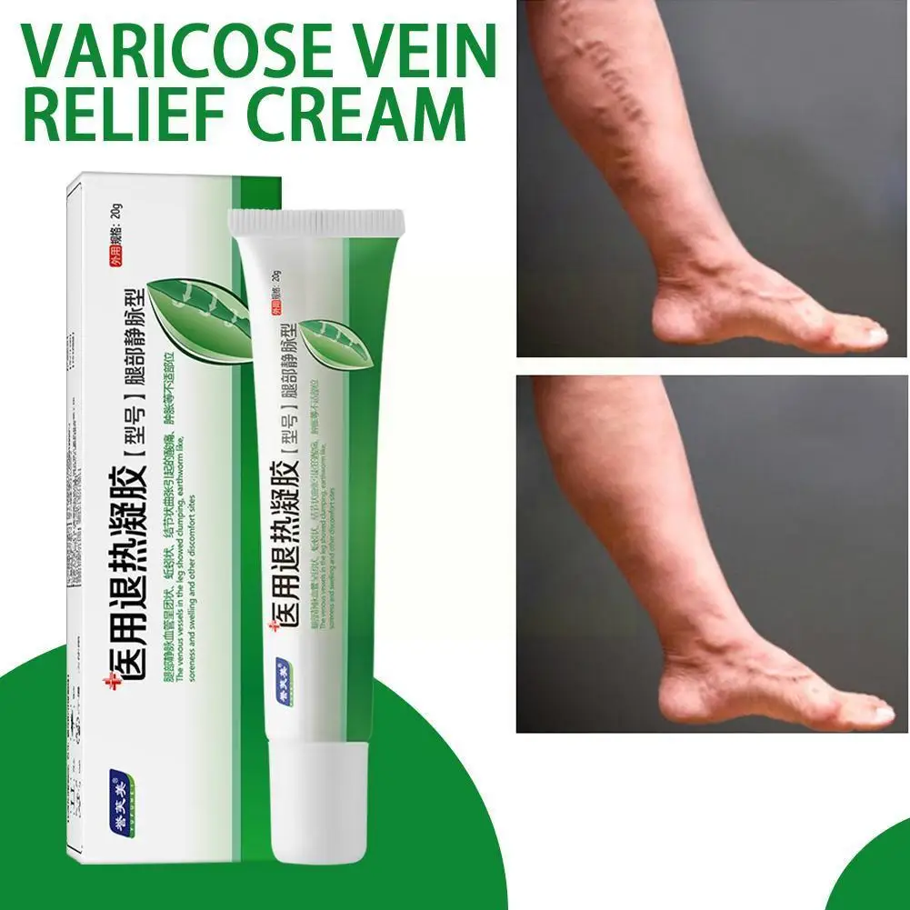 

20g Potent Formula Ointment For Varicose Veins Effective Varicose Vein Relief Cream To Relieve Vasculitis Phlebitis Spider H5L9