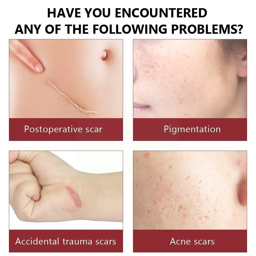 

Vibrant Glamour Scar Repair Serum Acne Treatment Stretch Marks Removal Acne Scar Whitening For Spots Skin Care 30 F7v7
