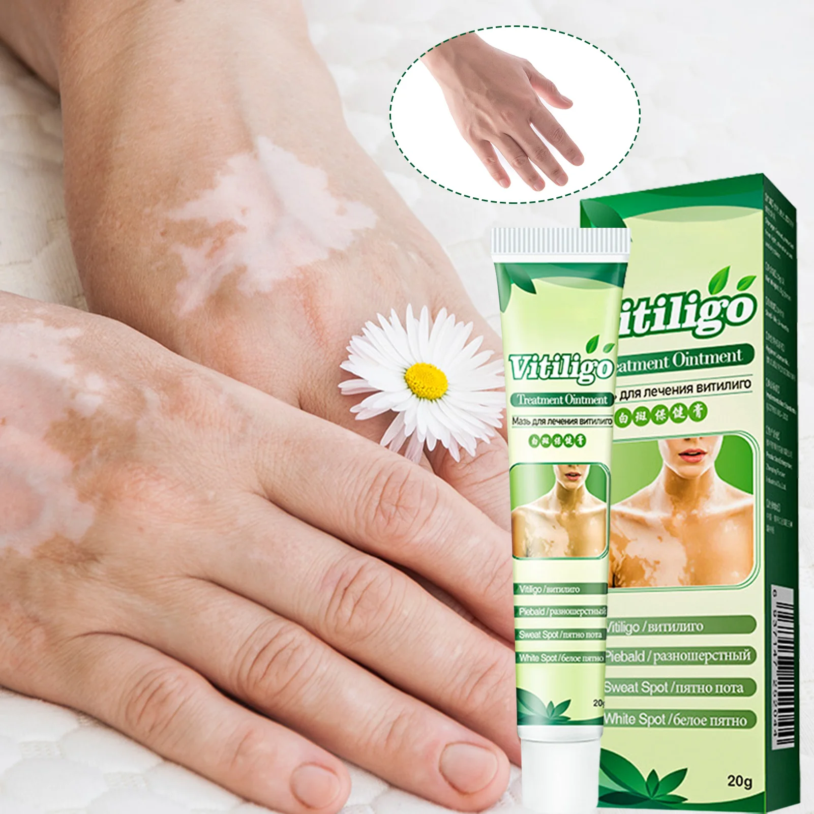 

20g Vitiligo Treatment Cream Skin Pigmentation Treatment Vitiligo Care Cream Or Skin Vitiligo Leukoplakia Improve Skin