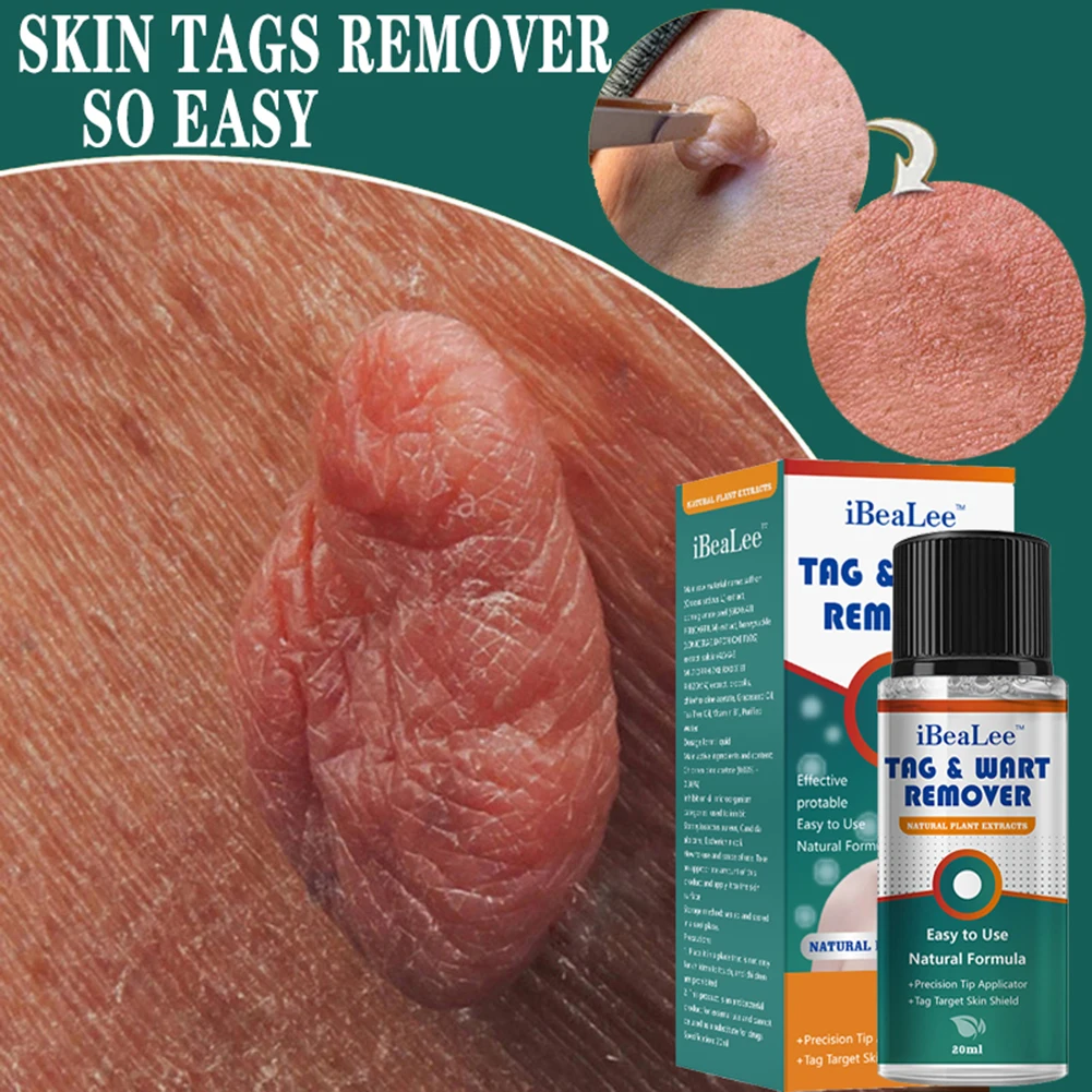 

Skin Tags Remover Painless Mole Skin Dark Spot Warts Remover Serum Freckle Face Wart Tag Treatment Removal Cream Essential Oil