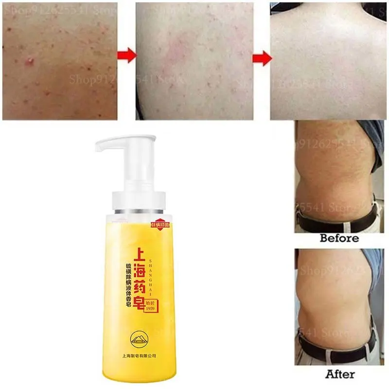 

Антибактериальное очищающее жидкое мыло против клещей и серы от зуда и угрей мягкое очищающее кожу лосьон для ванны уход за кожей