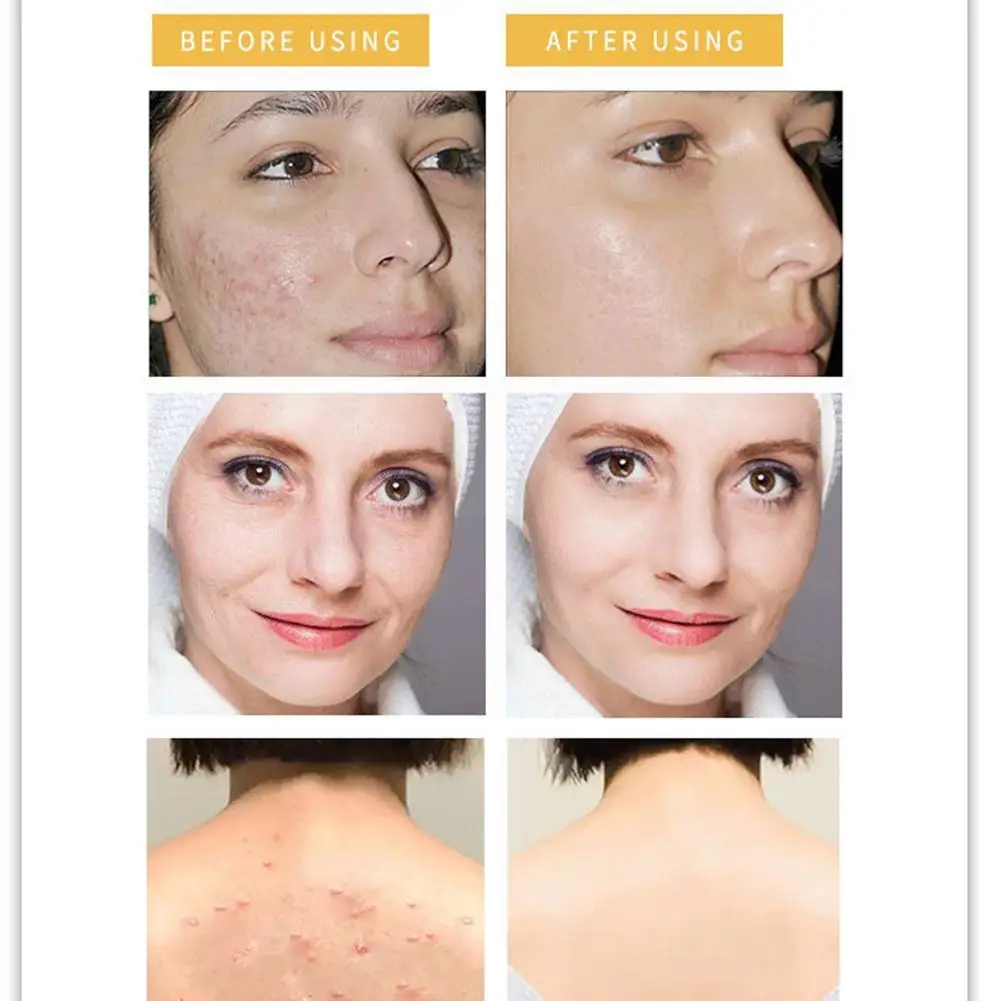 100 г куркума мыло Chniese травяное очищающее лечение акне питательное Отбеливающее