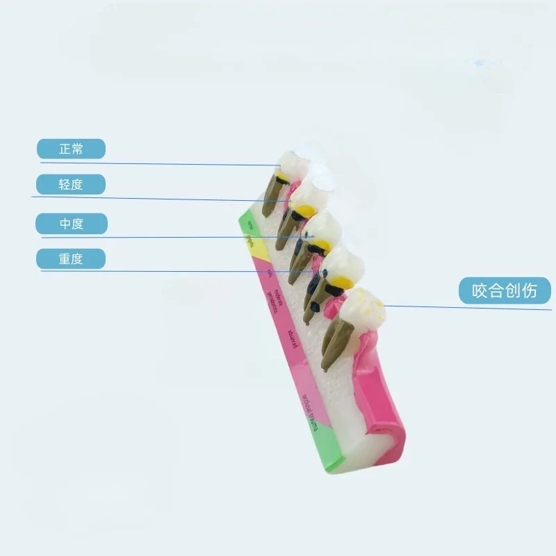 Модель пародонтита смола модель пародонтальной эволюции для взрослых