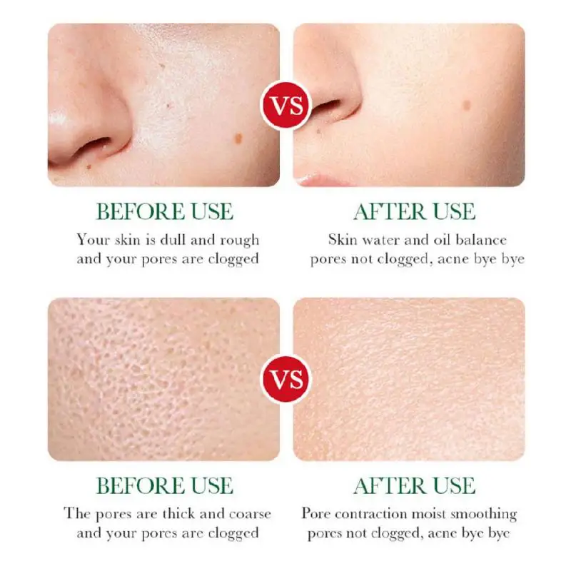 Сыворотка для удаления акне с салициловой кислотой средство лечения сужение пор