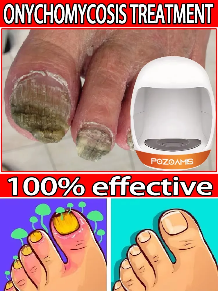 Деформированный терминал для ногтей Немезида кровотечения вросших