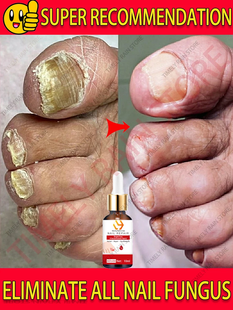 

Nail Fungal Treatment Essence Anti Infection Feet Cuticle Remove Care Serum Paronychia Onychomycosis Toe Nail Fungus Repair 10ml