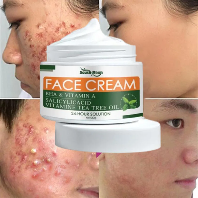 Tea Tree Salicylic acid Anti-Acne Cream Lighten Acne Scars Repair Acne Pits Facial Repair Cream Improve Acne Prone Skin Care