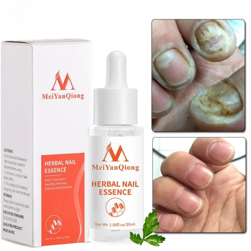 

Nail Treatment Essence Herb Serum Hand and Foot Care Nail Fungus Treatment Essence Nails Restore Nail Shine Nail Repair Oil 30ml