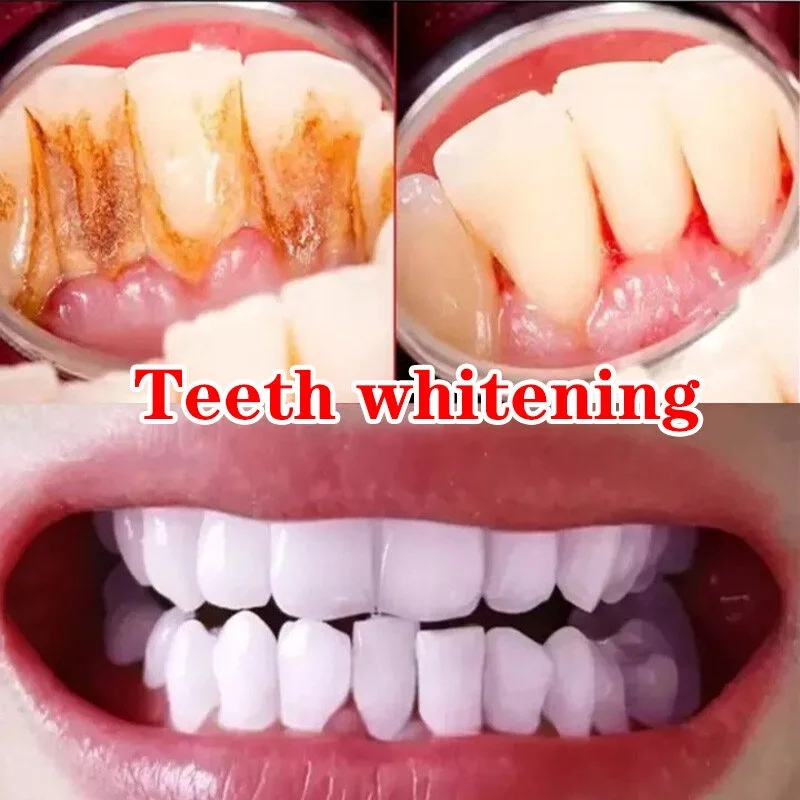 

Quick Repair of Cavities, Caries, Filling, Removal of Plaque, Stains, Decay, Whitening, Yellowing Repair Teeth Teeth Whitening