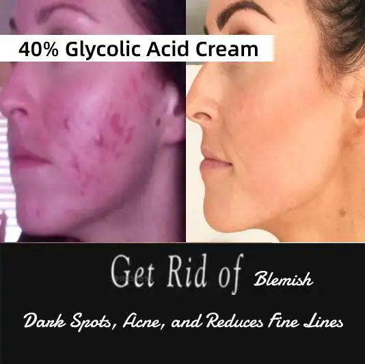 

40% Glycolic Acid Night Cream Skin Care – Moisturizing and Exfoliating Facial Peel, Dark Spot Blackhead Remover, Pore Treatment