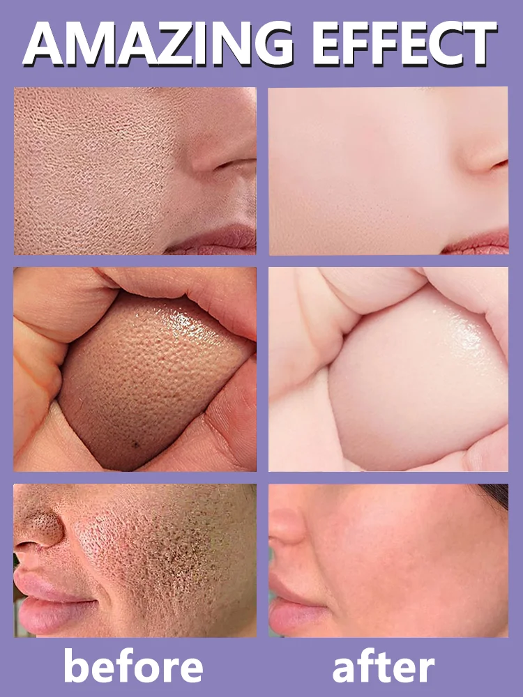 Решает большие проблемы с порами