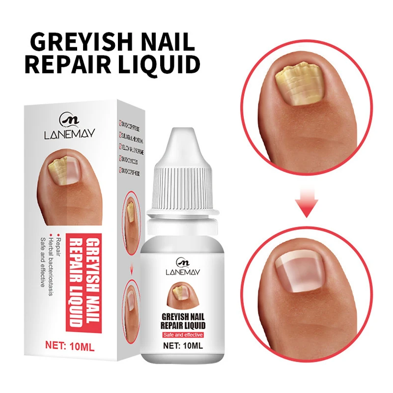 

Repair Nail Fungus Treatment Liquid Feet Care Essence Anti Infection Paronychia Onychomycosis Toe Nails Fungal Removal Gel Care