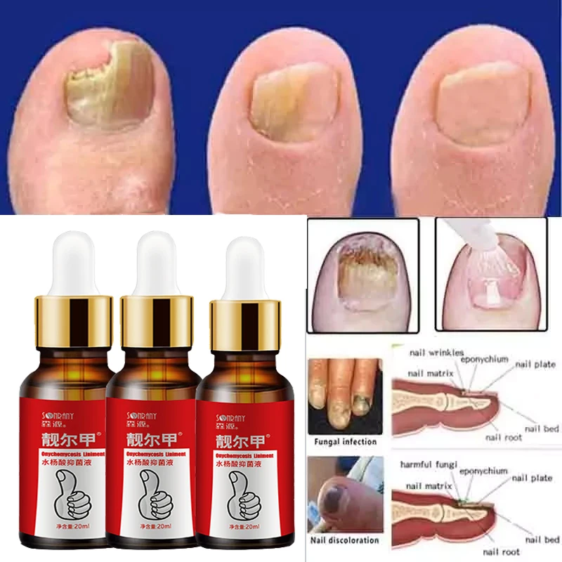 

Средство для лечения грибков ногтей, эссенция для ухода за ногами, отбеливание ногтей на ногах, удаление грибка на ногтях, антиинфекционный ...