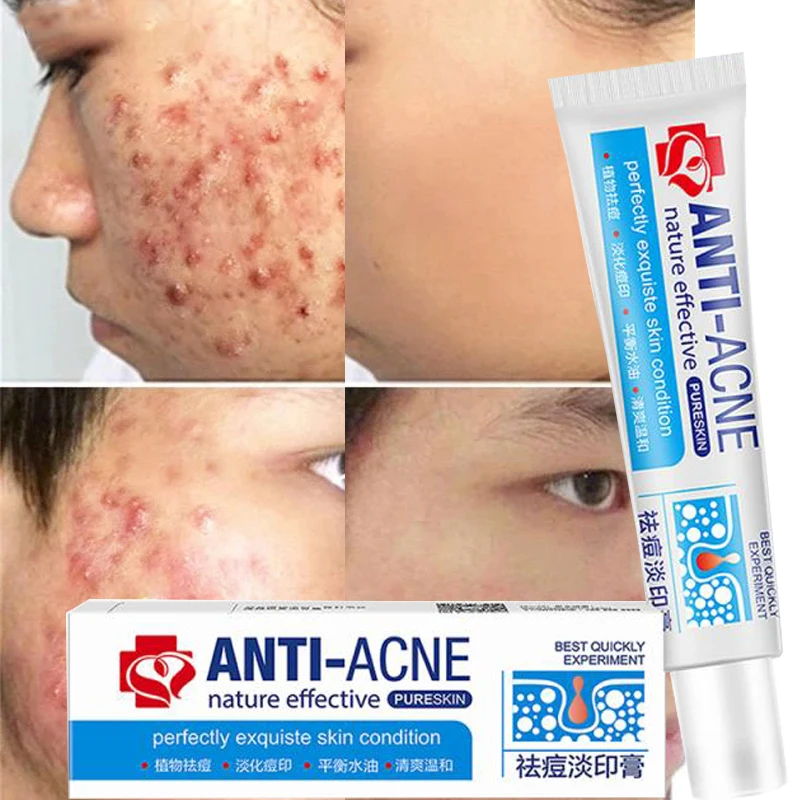 Chinese Effective Acne Cream Remove Pimples Dark Spots Acne Scars Cream Shrink Pores Deep Oil Control Whitening Cream Skin Care