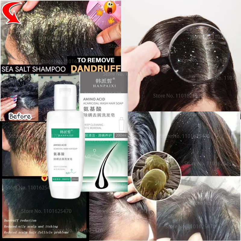 

AMINO ACID ACARICIDAL WASH HAIR Shampoo Cream Soap,Itching Scalp ,Dandruff,Control Oil,Refreshing Hair Care ,Beauty Product