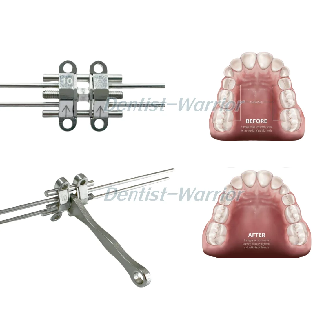 MSE стоматологический ортодонтический расширительный винт для среднего лица