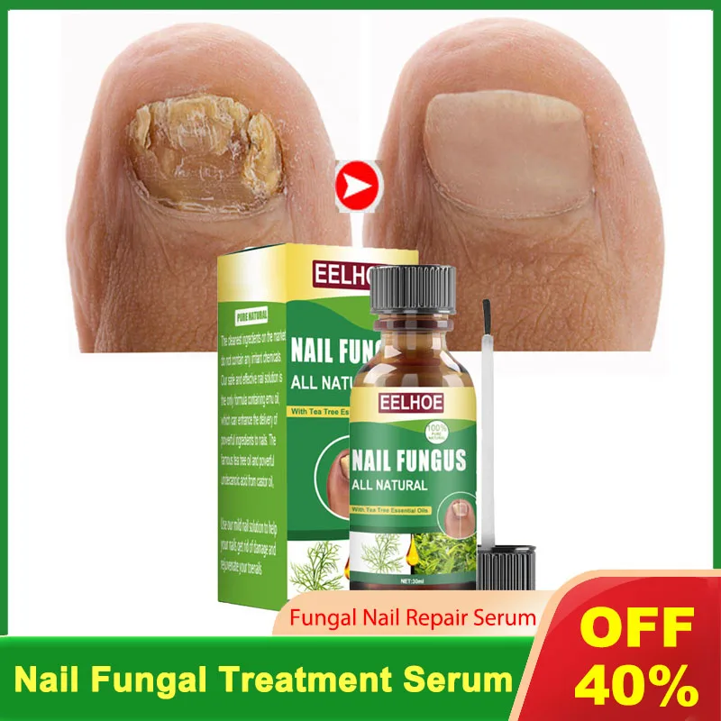 

30ml Nail Fungal Treatment Feet Serum Anti Infection Foot Toe Fungus Removal Essence Gel Onychomycosis Paronychia Repair Care