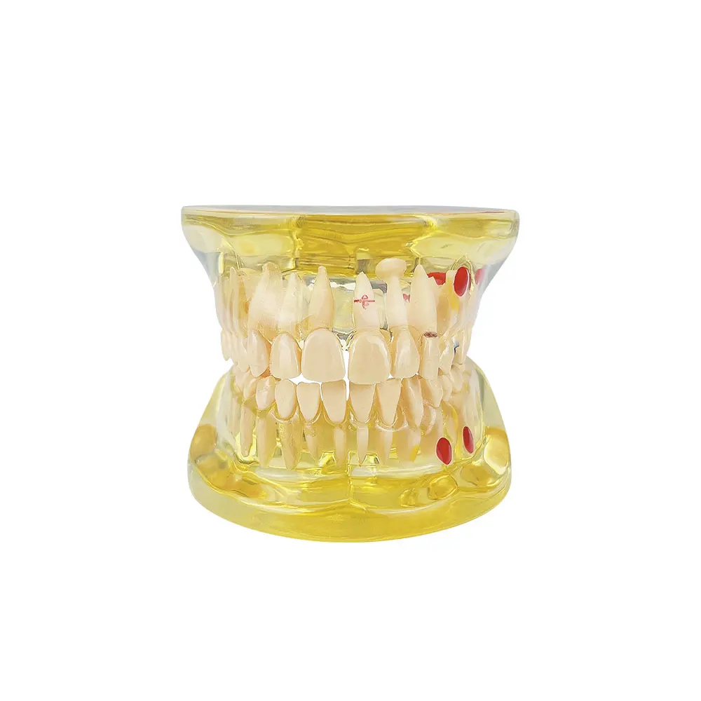 Модель для обучения стоматологии полусъемные зубы патологическая модель