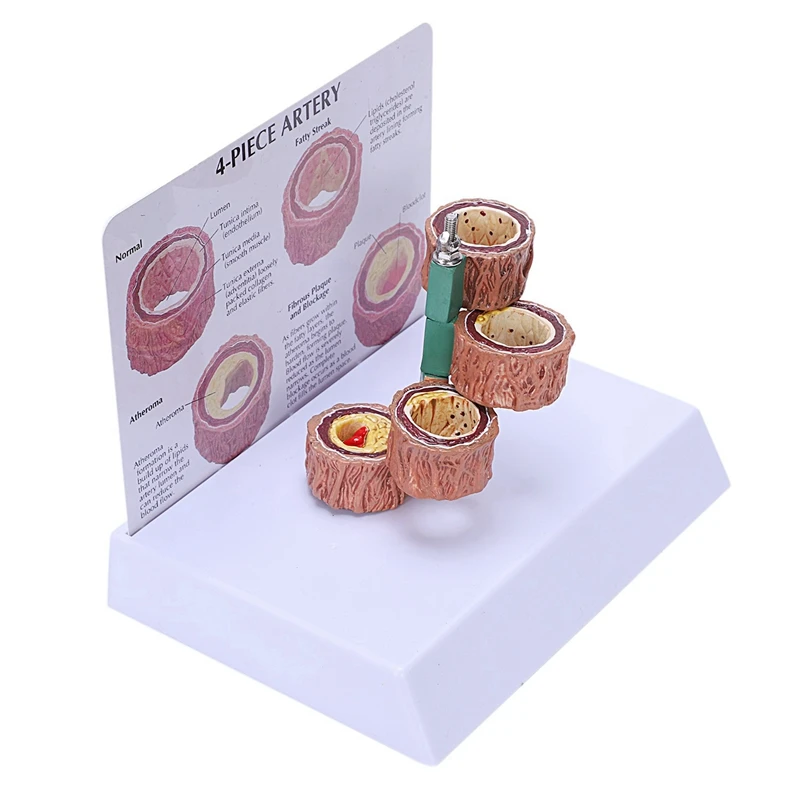 

2X Atherosclerosis Thrombosis Model Vascular Disease Demonstration Heart Vascular Pathology Model