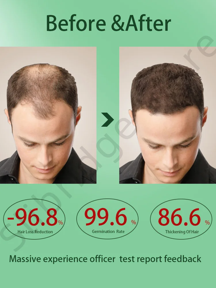 

Fast Hair Growth Hair Follicle Treatment Hair Growth Seborrheic Alopecia Hairline Upward Postpartum Hair Loss Baldness Hair Loss