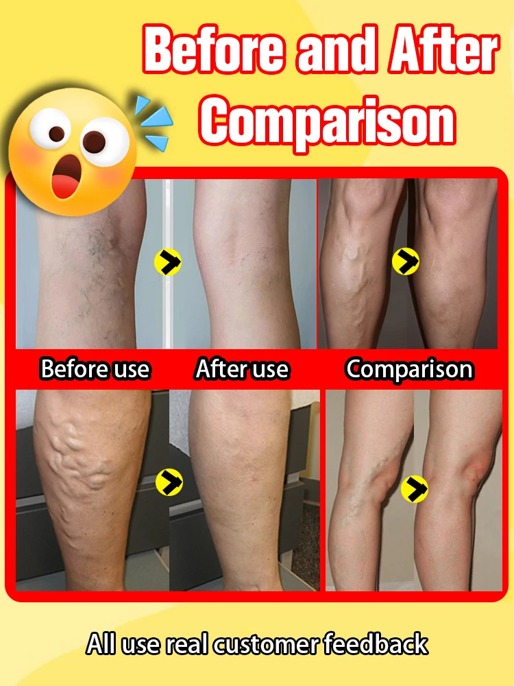 Крем-лазер Varicosse