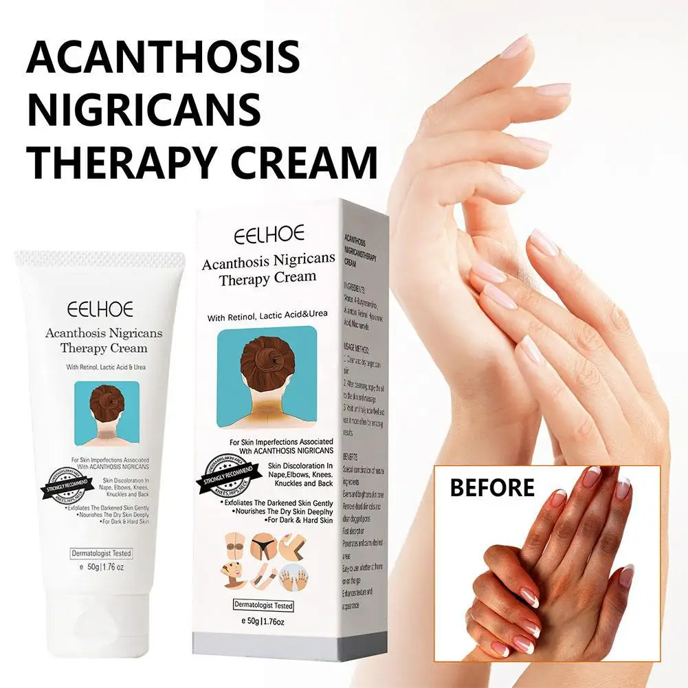 

Acanthosis Nigricans Treatment Oil Removal Face Cream Clears Pimple Scar Black Dots Gel Treat Acne Shrink Pore Whiten Cream 50ml