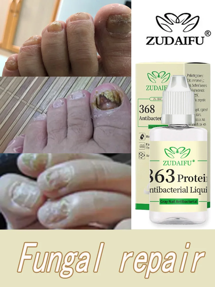 

ZUDAIFU Foot Nail Fungus Treatment Serum Anti Fungi Feet Care Against Fungal Nail Polish Oil Antifungal Drops Removes Gel 20ml