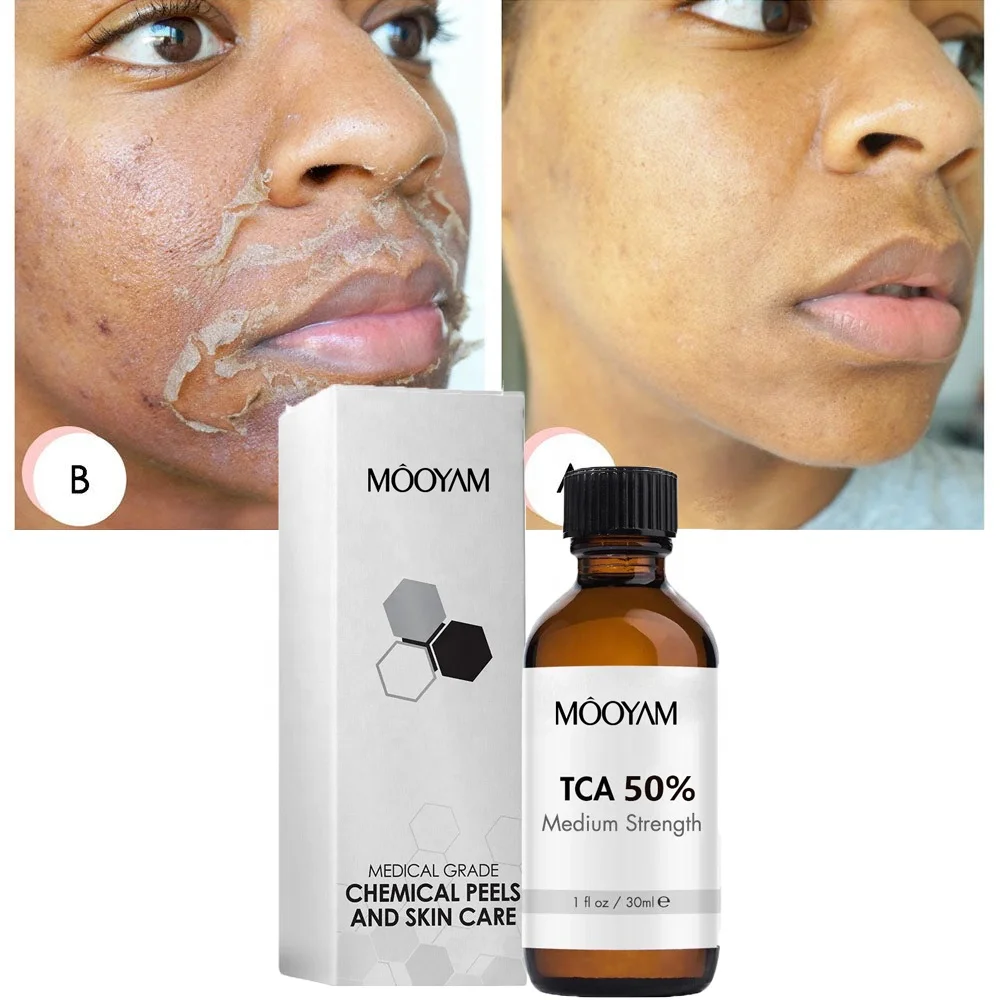 

TCA 50% Chemical Peel Tca Peel Acid Peeling Acid 7-15 Days Delivered Skin Superforce Peeling Pigmentation Acne Scar BrightenSkin