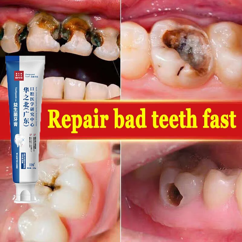 

Teeth Whitening Toothpaste Quick Repair Of Cavities Removal Of Plaque Stains Decay Fresh Breath Removal Of Plaque Repair Teeth