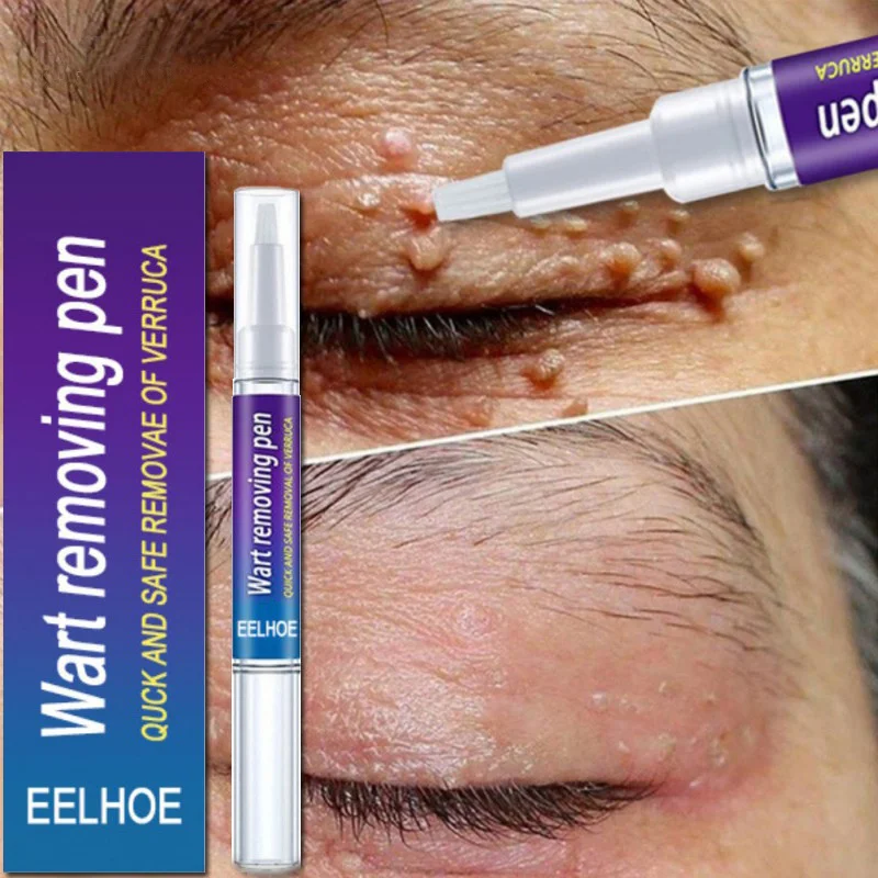 

Wart Removal Liquid Pen Skin Tag Remover Painless Treatment Papillomas Mole Wart Genitals Dark Spot Corn Plaster Body Skin Care