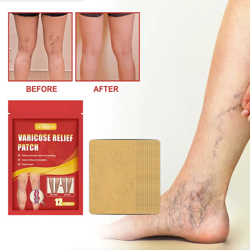 Varicose Veins Vasculitis Patch Vascular Veins Remover Spider Legs Treatment Chinese Medical Plaster Angiitis Stickers Skin Care