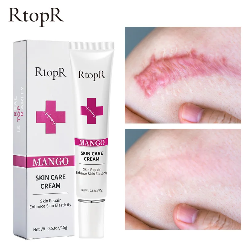 

RtopR Scar Cream Gently Removes Scars Repairs Skin Rejuvenates Whitens Skin Treats Scars Accelerates Collagen Formation