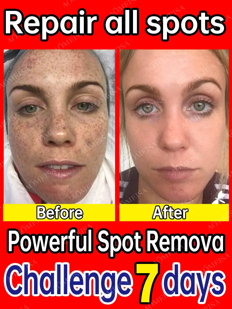 

Freckles Removal Essence Remove Facial Spots Skin Dark Spot Remove Melasma Spots Sunspots Whitening And Freckle Removing Cream